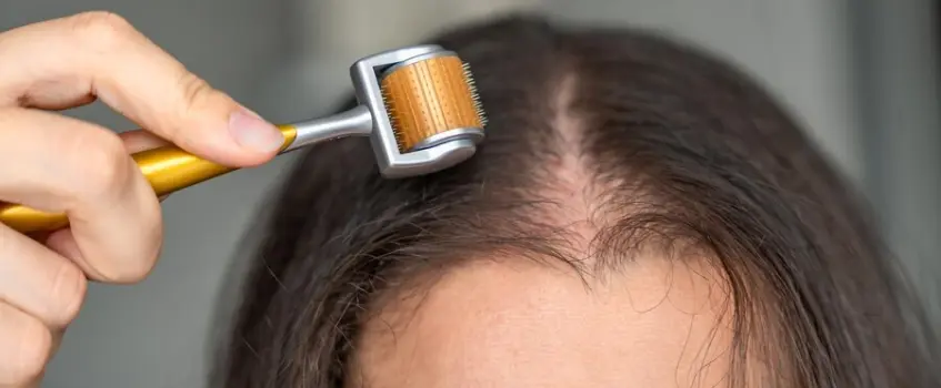 Derma Roller for Hair Loss How to Get the Best Results Rolling